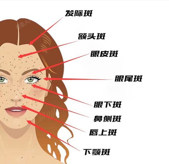 斑点的出现位置与原因: 1,发际斑:妇科疾病导致女性激素分泌