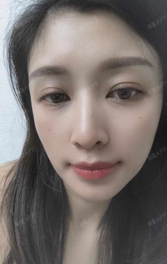 半永久美瞳线好不好_效果图_洋气娃娃是谁半永久美瞳线术后第44天