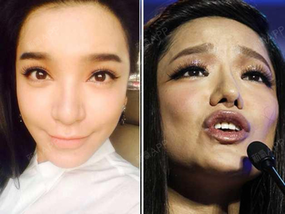 张雨绮鼻子歪到天边,鼻孔还一大一小,难道做了娜扎同_圈子-新氧美容