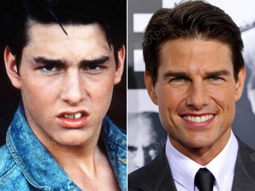 那些过了青春期才开始整牙的明星们