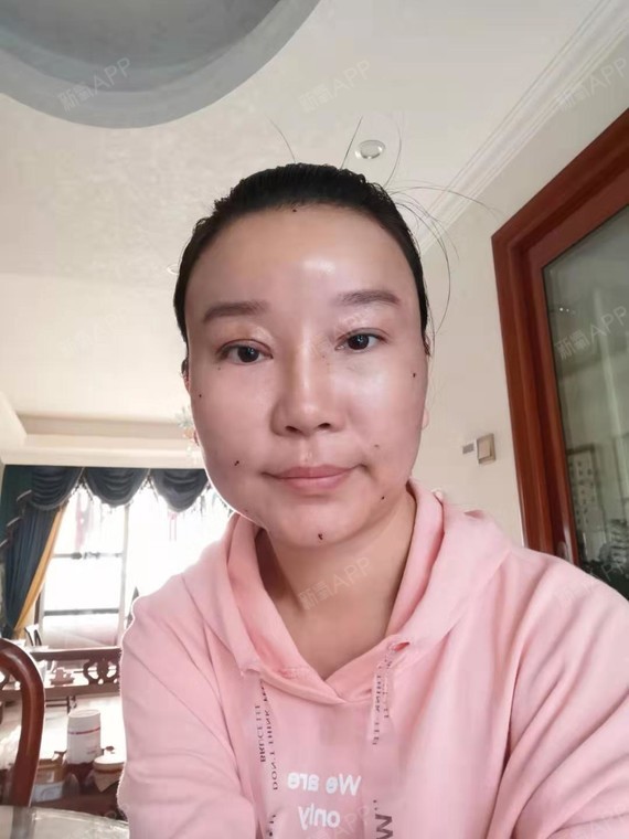 第三天,简单跟大家分享下现在的情况,做完线雕提升手_圈子-新氧美容