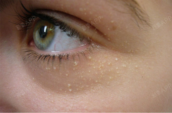 脂肪粒影响颜值 去除眼周小颗粒妙招看这里 有些女性 圈子 新氧美容整形