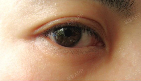 首页 此页面仅支持预览 Avatar 温国军 87篇日记 脂肪粒影响颜值 去除眼周小颗粒妙招看这里 有些女性眼睛周围会出现一些白色的小疙瘩 摸起来硬硬的 虽然不大 但是影响整体的美观 大多数人不在乎 但是做平面模特这一行时很注重皮肤美容的 所以也