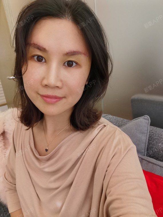 切眉术后3天了,恢复的很好.