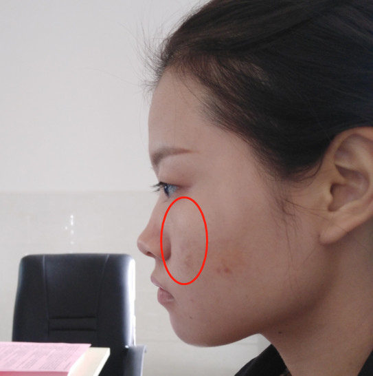 总感觉自己面中发育不全,我这是不是鼻基底凹陷啊?