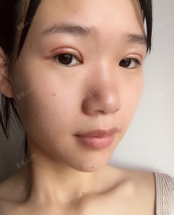 长沙定点双眼皮好不好_效果图_氧气4f1le定点双眼皮术后第1天_新氧