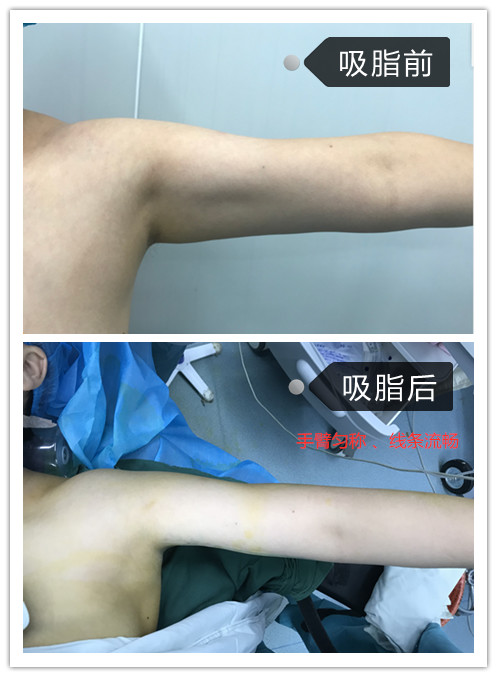 吸脂手术会痛吗伤口会不会留疤