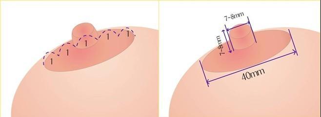 激光漂红乳晕的原理是什么 新氧美容整形