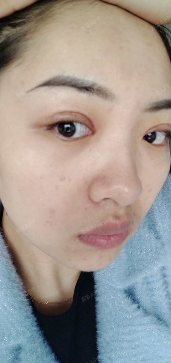 术后一个月,拆线后果然恢复的更快,没有了肉条感(前_圈子-新氧美容