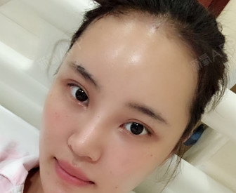 填充完的第十天了,现在额头都是锃亮锃亮的,我希望后期脂肪的