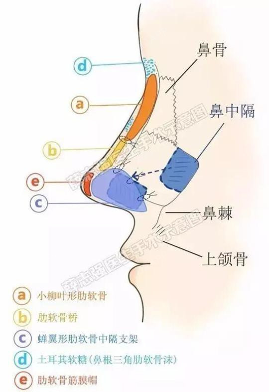 全肋软骨隆鼻和半肋软骨隆鼻区别在哪哪个好