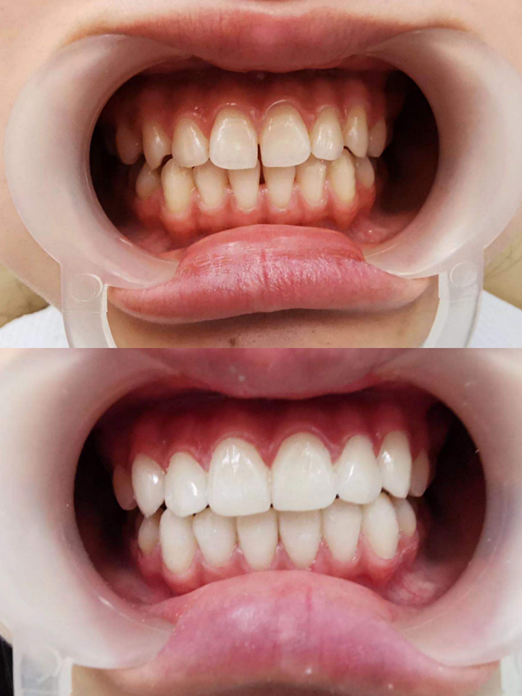 超薄瓷贴面修复心得整牙全过程揭秘92