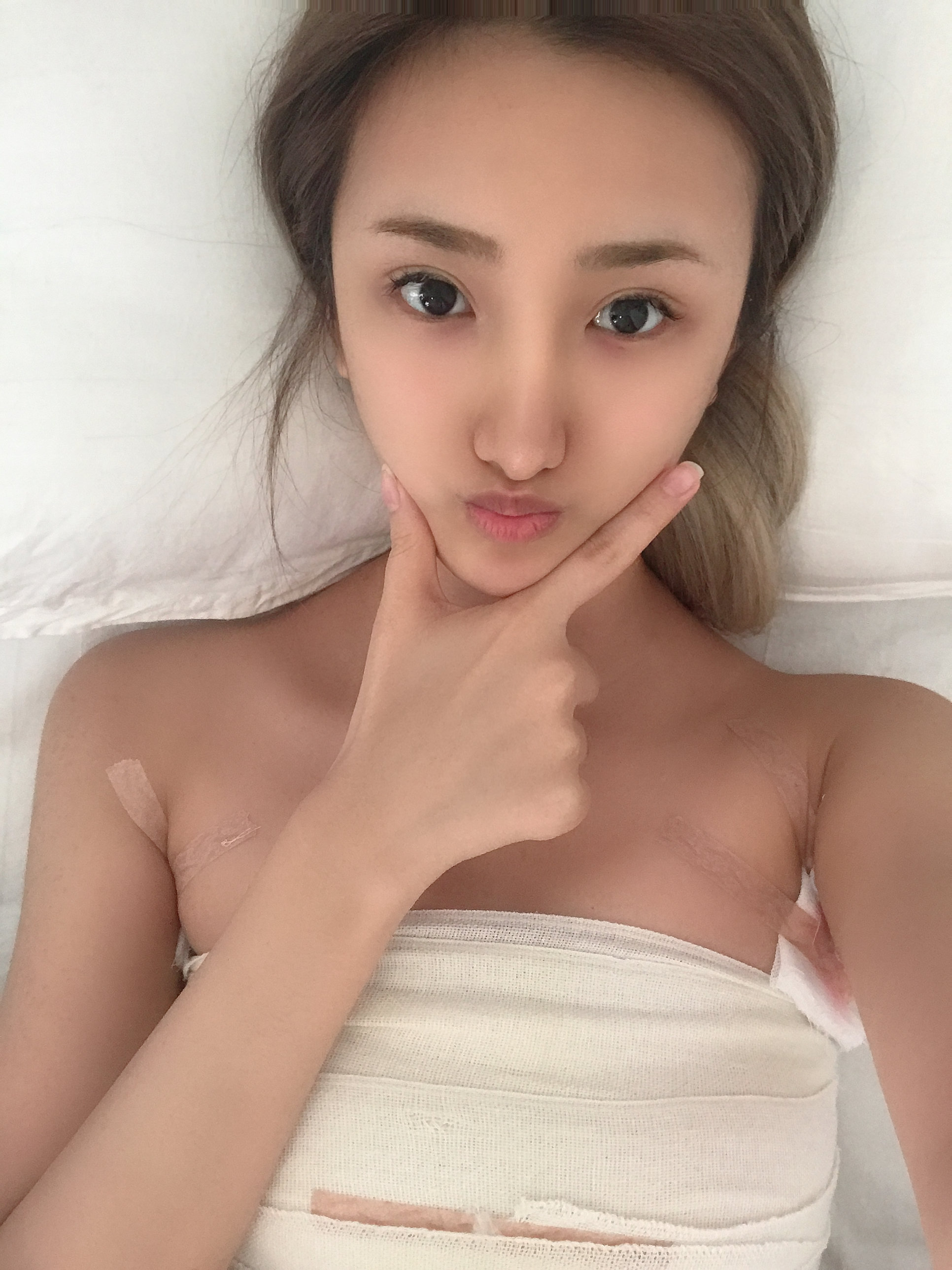 假体隆胸怎么样_恢复过程_效果如何_氧气w2t388e整形日记5.