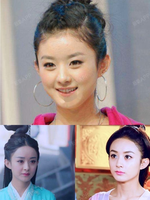 发际线上移,发量少适合的发型77植发经验分享 美女明_圈子-新氧美容