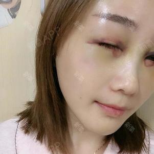 深圳眶隔脂肪释放好不好_效果图_氧气403ux眶隔脂肪释放术后第0天