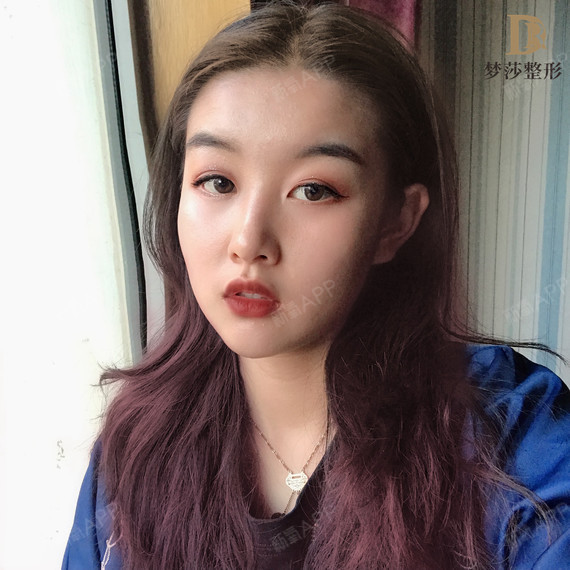 整个脸现在恢复的超级自然_圈子-新氧美容整形