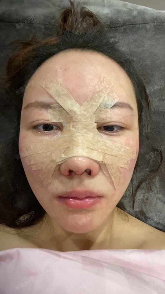 这是我第三次隆鼻术后的第一天