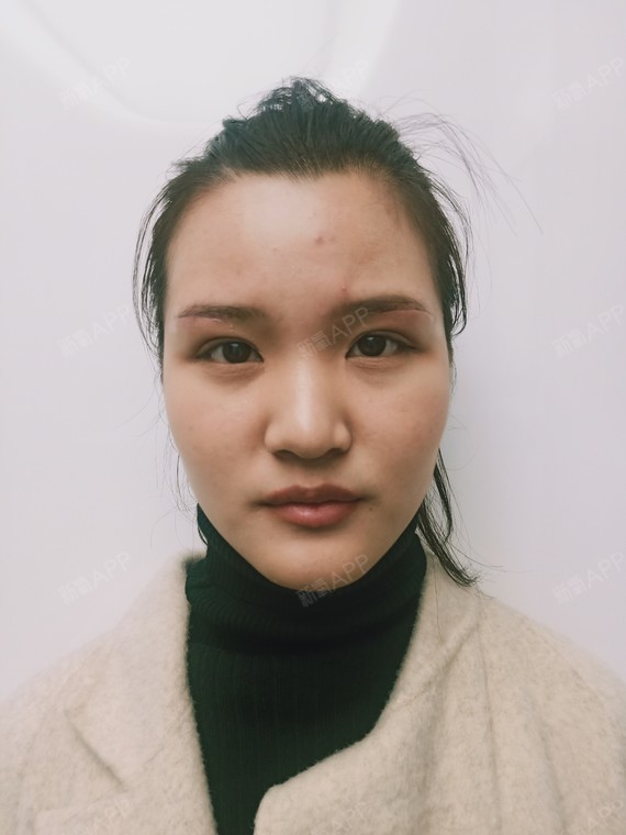 切眉术好不好_效果图_氧气iyad557切眉术术后第7天_新氧美容整形
