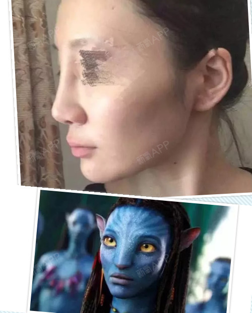 细!如果鼻梁过宽,会显得粗笨,甚至畸形,变成"阿凡达鼻子".