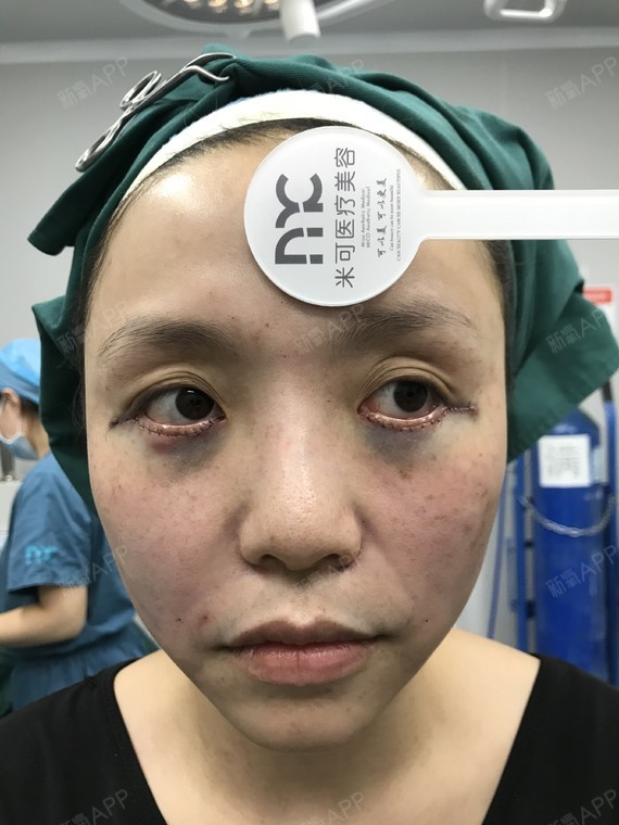 外切去眼袋好不好_效果图_lost失去外切去眼袋术后第1天_新氧美容整形