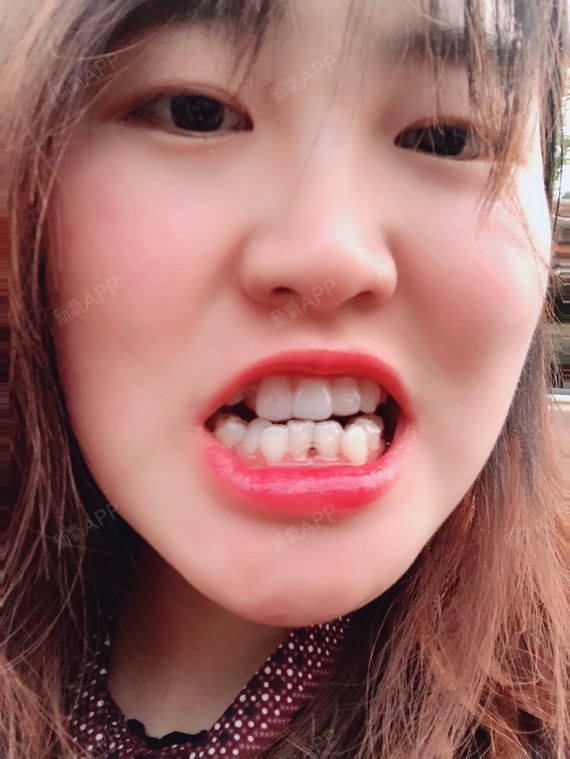 带隐形牙套已经好长时间了,已经戴到第6副的第10天_圈子-新氧美容整形