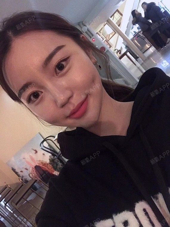 术后一个月韩院长说人造酒窝术后要注意日常的口腔卫生_圈子-新氧美容