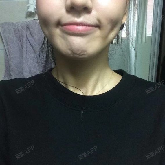 自己的本来的酒窝 ,一遍不太明显 总感觉面部不对称似的