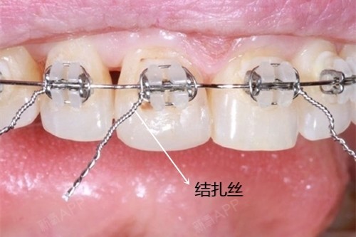 普通托槽和自锁托槽图片