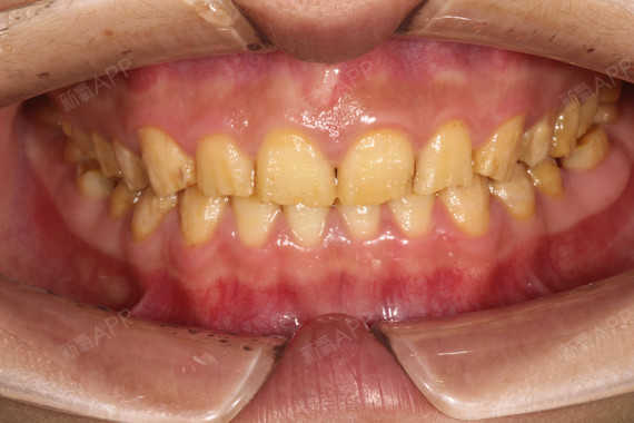 我之前真的是大黄牙,怎么刷牙都刷不干净,并且某宝上_圈子-新氧美容整