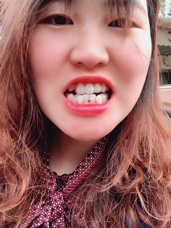 带隐形牙套已经好长时间了,已经戴到第6副的第10天_圈子-新氧美容整形