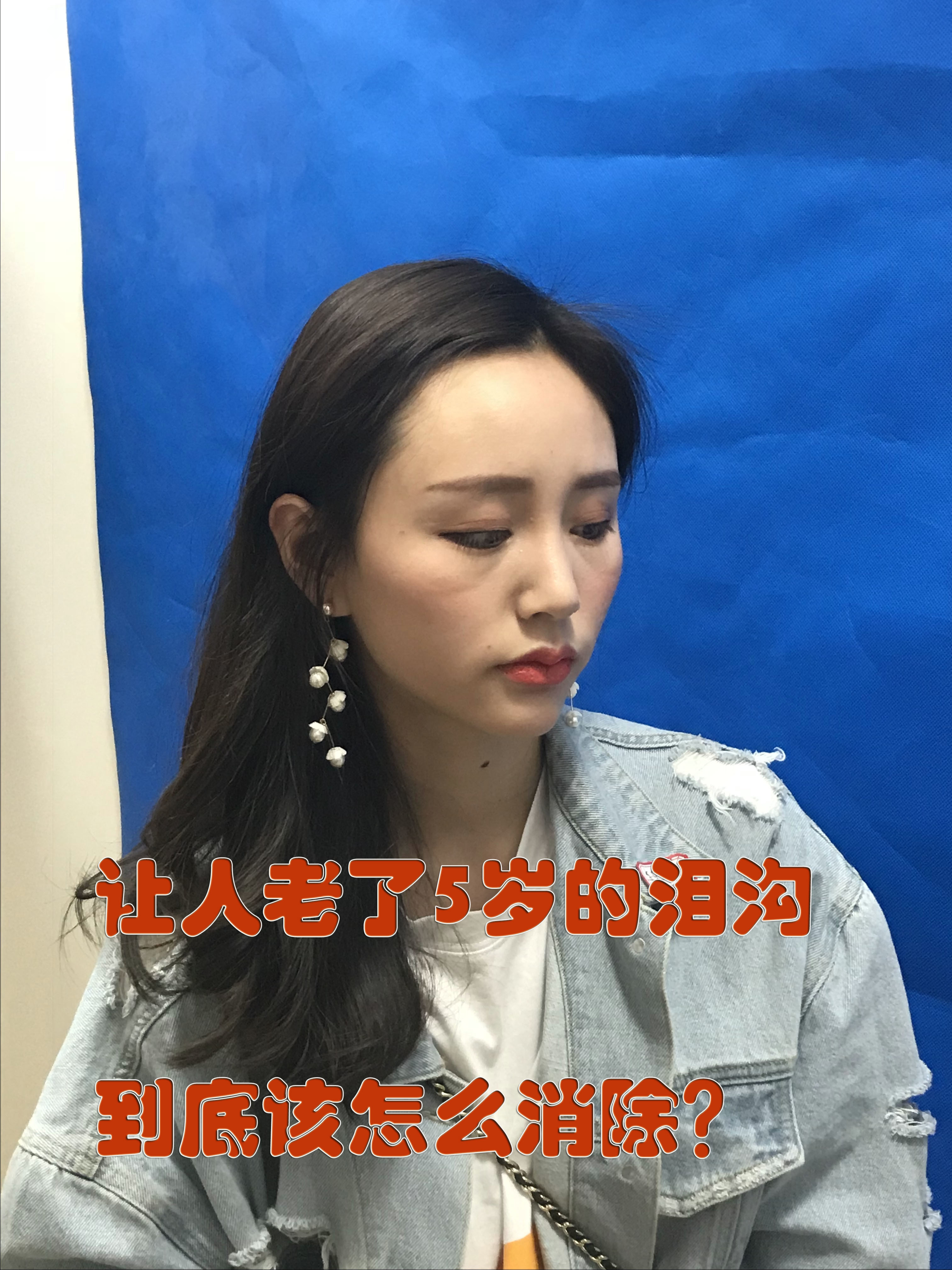 科普解决显老泪沟的三大办法