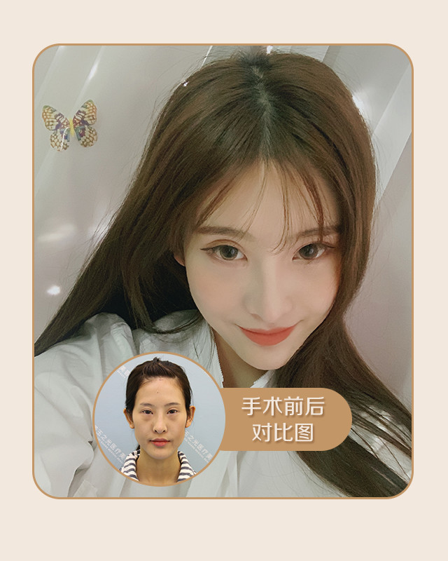 蛋白填充脸会硬吗_蛋白填充脸部能保持多久_自体胶原蛋白填充面部能维持多久