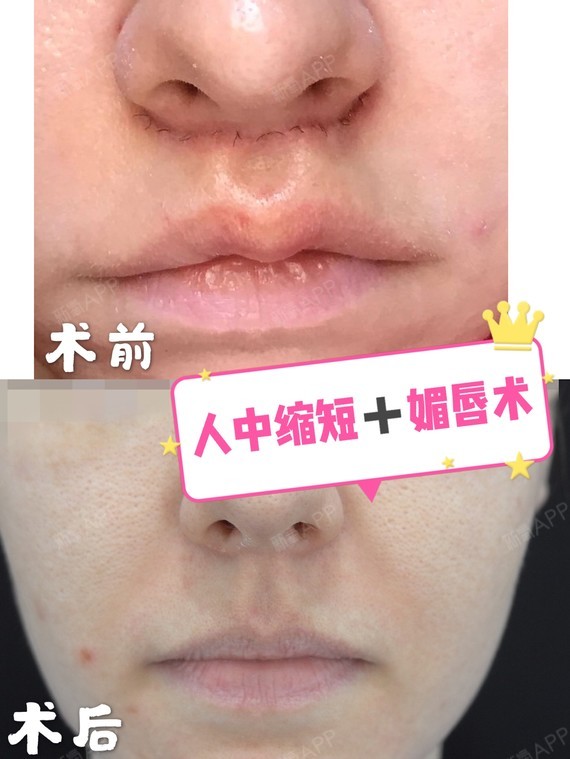 人中缩短术好不好_效果图_氧气4kssa人中缩短术术后第4天_新氧美容