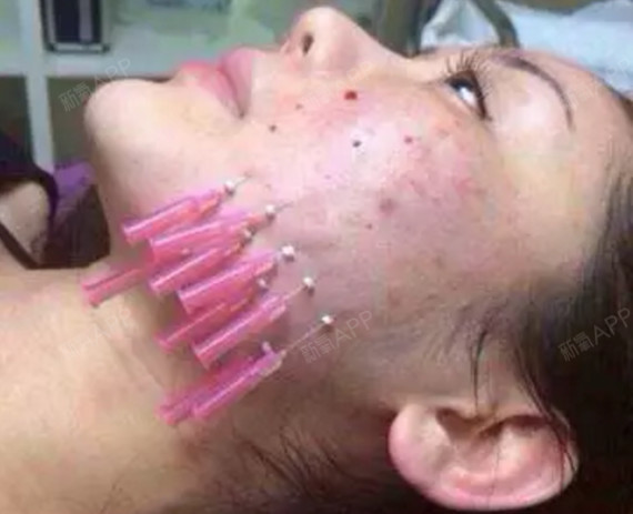 做了大v线雕怎么保养?