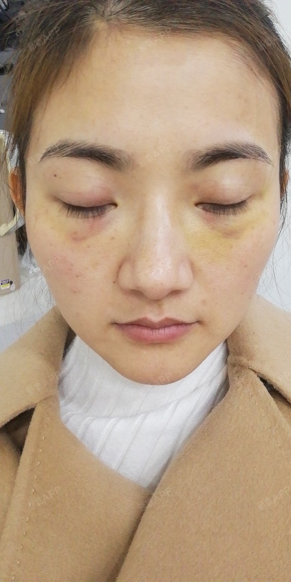 【芜湖瑞丽医疗美容 内吸祛眼袋 术后8天】岁月不饶_圈子-新氧美容