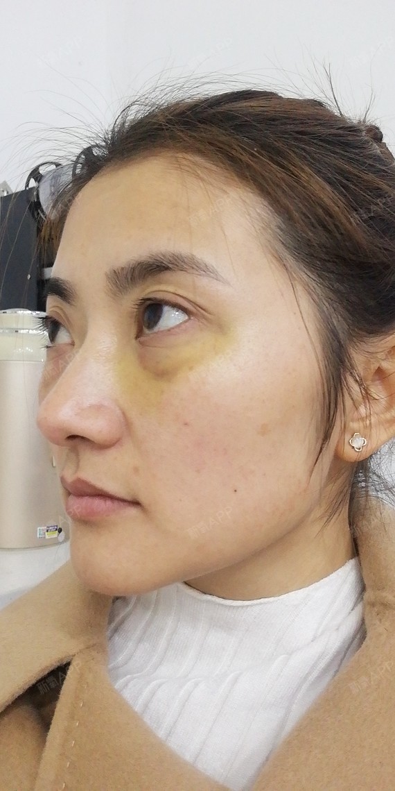 【芜湖瑞丽医疗美容 内吸祛眼袋 术后8天】岁月不饶_圈子-新氧美容