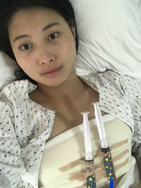 【南京美贝尔整形医院-假体隆胸】我胸部特别平,以前_圈子-新氧美容
