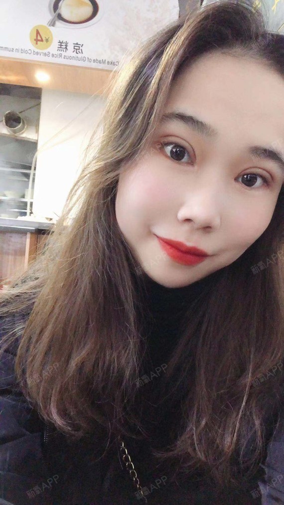 做双眼皮手术有半个月了,双眼皮现在看起来自然_圈子-新氧美容整形