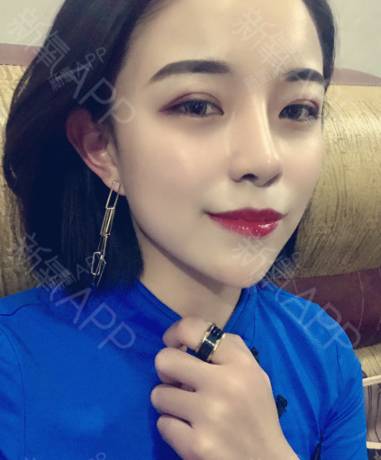 自从做完玻尿酸丰下巴之后,我的脸型整体小了一圈了,_圈子-新氧美容