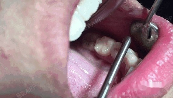 洗牙好不好 好 洗牙对牙齿保健意义重大 能有效清除 圈子 新氧美容整形