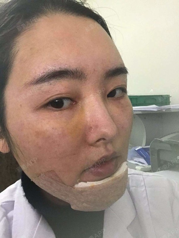 我前两天去把假体取出来了所以现在下巴是这个样子