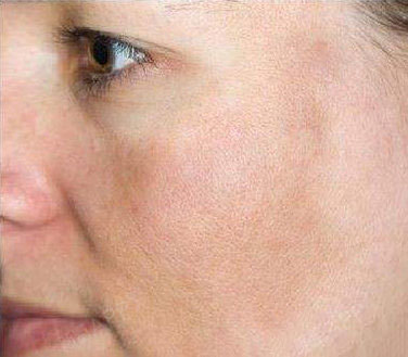 皮肤治疗后出现色沉怎么办