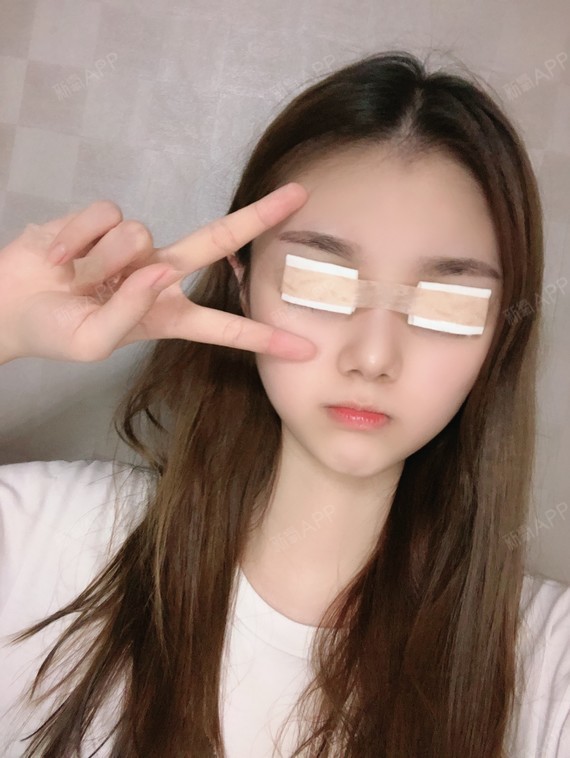 今天是做完双眼皮手术之后的第1天,眼睛上还蒙着纱布_圈子-新氧美容