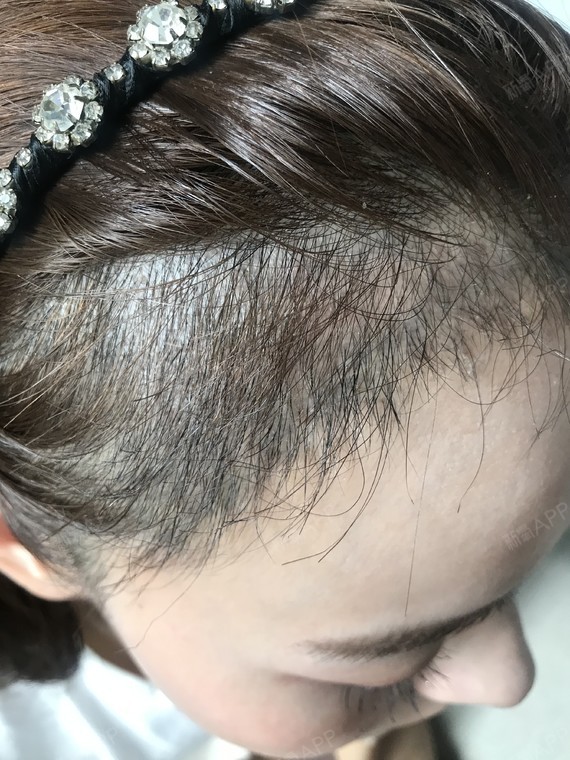 植发际线100天//关于植发际线后发型的一些建议!
