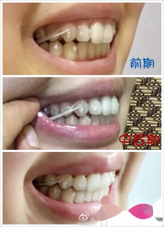 当年"驴板儿牙""大板儿牙"的外号可谓童年阴影啊!