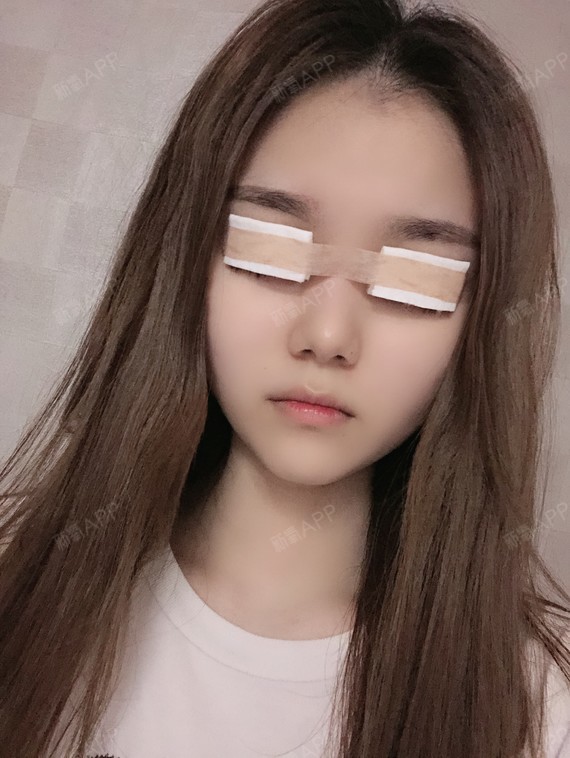 今天是做完双眼皮手术之后的第1天,眼睛上还蒙着纱布_圈子-新氧美容