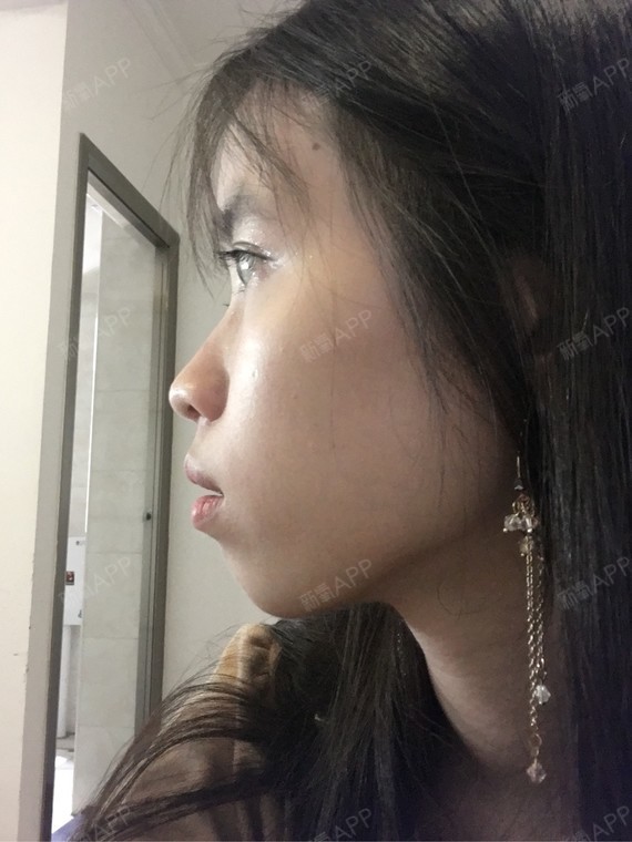 马上就要去矫正牙齿了