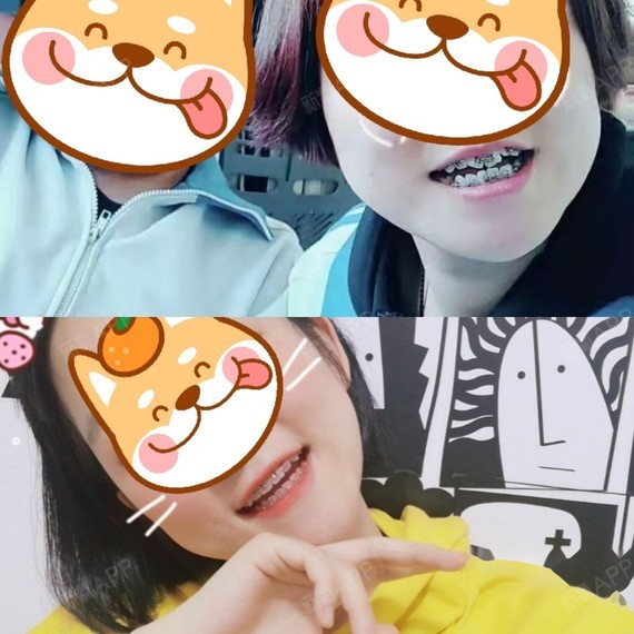 1.8正式带上了牙套 成为一名牙套妹