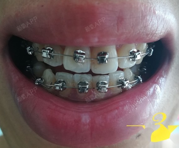 与之前相,差异主要体现在2号牙和3号牙之间的牙缝上,已经有了明显