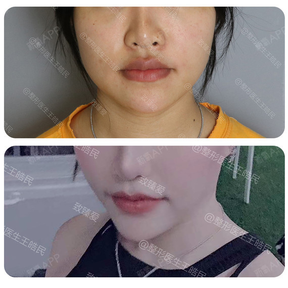 厚唇改薄好不好_效果图_致臻爱小白厚唇改薄术后第3天_新氧美容整形